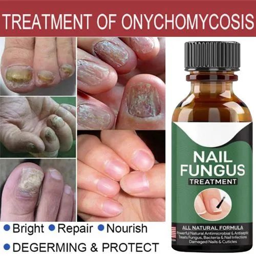 Fast Nail Fungus Treatment Gel – Nail Repair Essence Serum for Healthy, Smooth & Strong Nails